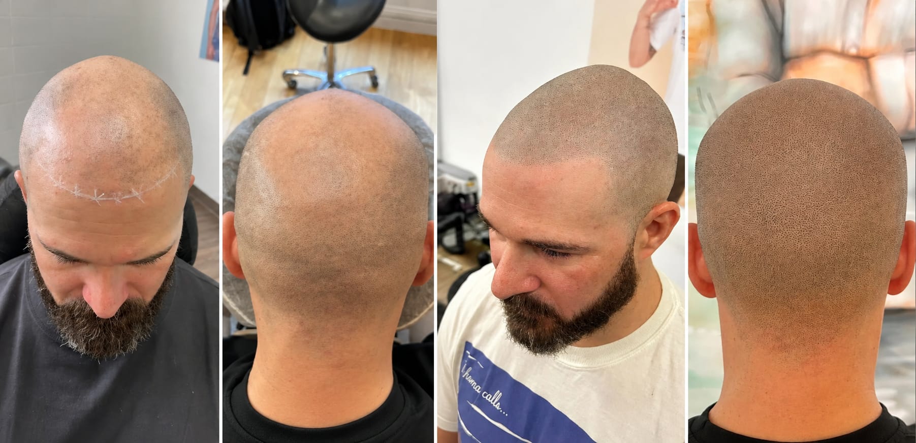 SMP-resultat – naturlig scalp micropigmentation, Dark Tattoos Sweden