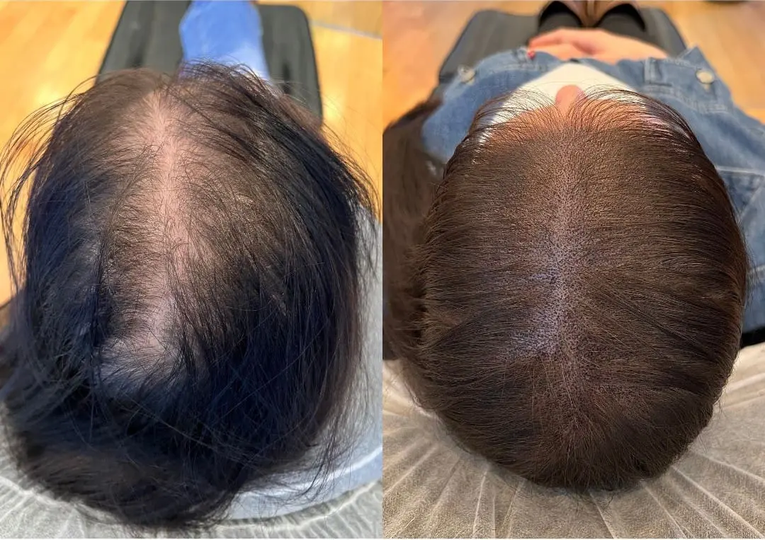 SMP för kvinnor med håravfall – fylligare hårbotten med scalp micropigmentation, Dark Tattoos Sweden