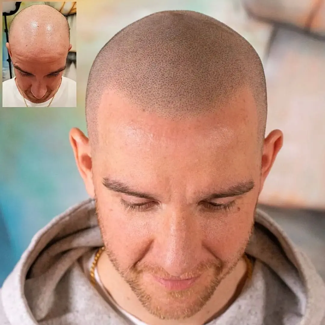Micro scalping SMP – precision och naturlig täthet i hårbottnen, Dark Tattoos Sweden