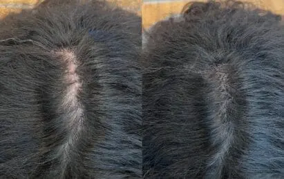 SMP-resultat närbild – naturliga pigmentprickar som imiterar hårfolliklar, Dark Tattoos Sweden