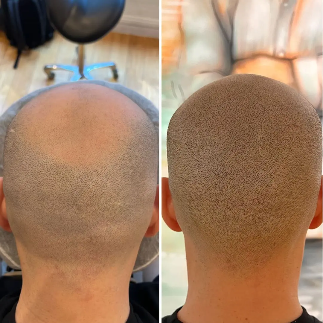 SMP med internationell standard – naturlig hårlinje och tätt pigmenteringsresultat, Dark Tattoos Sweden