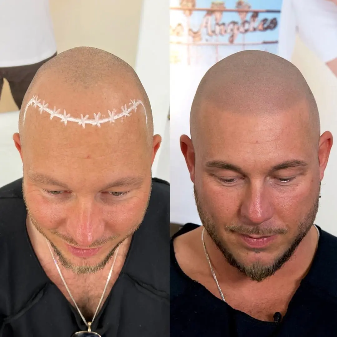 Scalp micropigmentation resultat – tätt och naturligt utseende utan kirurgi, Dark Tattoos Sweden