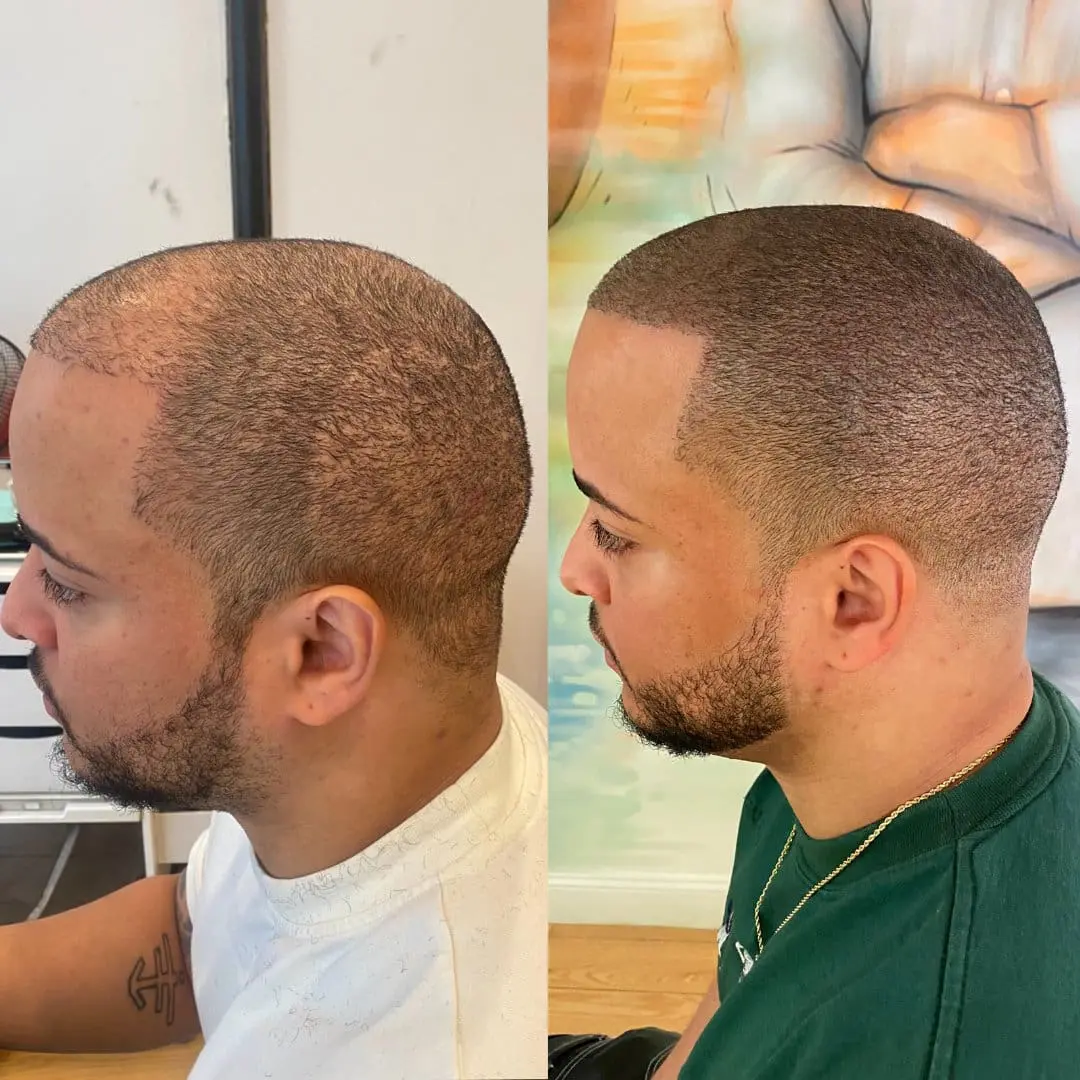 Scalp tattoo SMP – naturlig pigmentering och precision i hårbottnen, Dark Tattoos Sweden
