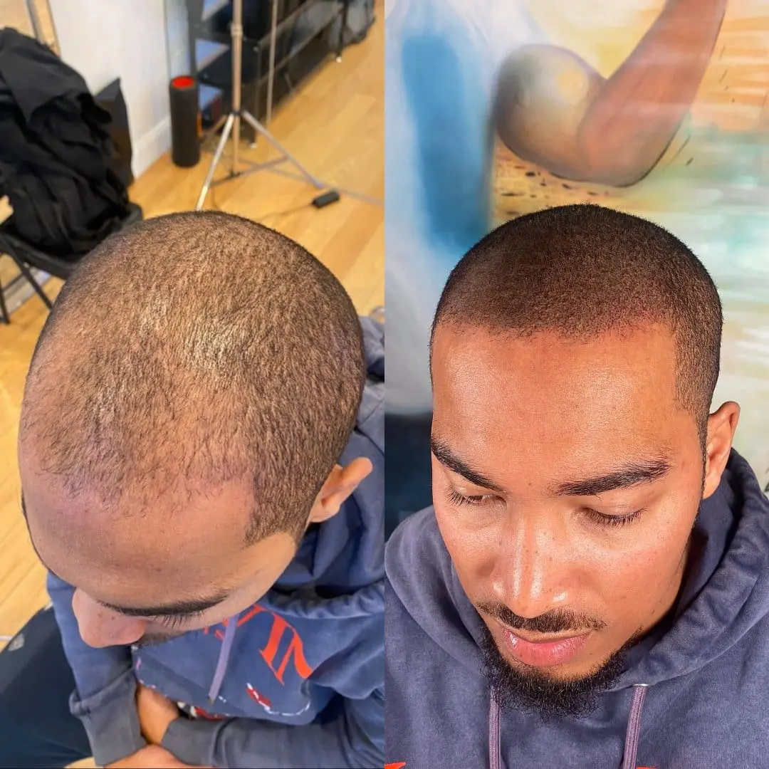 SMP Florida-stil – skarp hårlinje och tätt resultat med scalp micropigmentation, Dark Tattoos Sweden